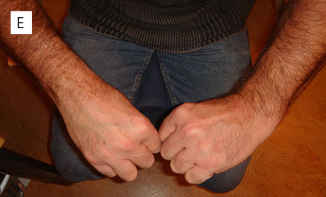 Figur 3. Kontroll etter 4 år. a. Tett ben-implantat kontakt uten tegn til løsning. Pasienten er smertefri, har god bevegelighet i det opererte høyre håndledd (b-e) og god kraft. 